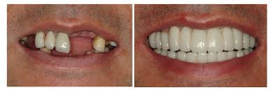 Gum Surgery